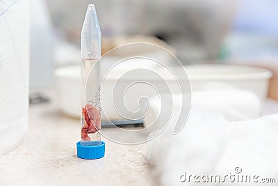 A tissue sample from the tumor to be sent for histological expertise Stock Photo