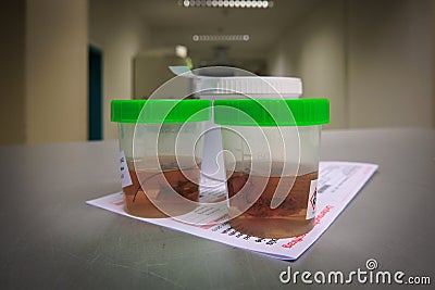 Tissue samples are placed in formalin for subsequent examination by a pathologist Stock Photo