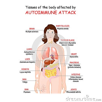 Tissues of the body affected by autoimmune attack Vector Illustration