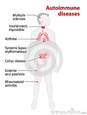 Tissues of the human body affected by autoimmune attack Vector Illustration