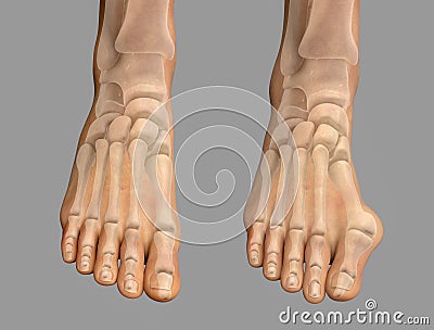 Toe deformation, also known as hallux valgus, or bunion Cartoon Illustration