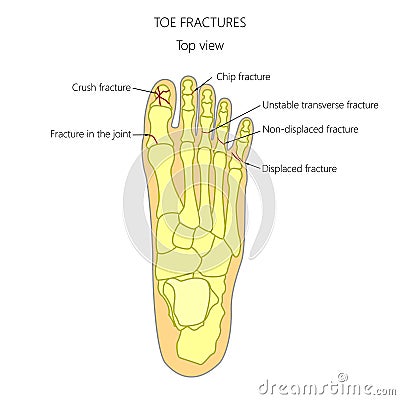 Toe fractures Vector Illustration