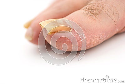 Toenail Fungus Stock Photo