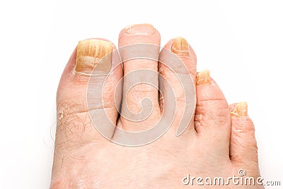 Toenail Fungus Stock Photo