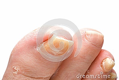 Toenail Fungus Stock Photo