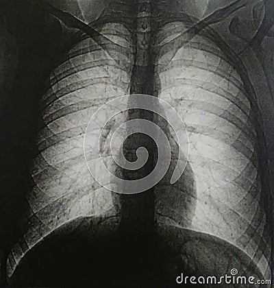 Tomography of human chest no pathologies Stock Photo