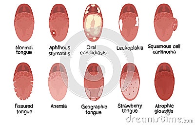 Tongue disease illustration Cartoon Illustration