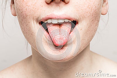 Tongue open mouth Young beautiful freckles woman face portrait with healthy skin Stock Photo