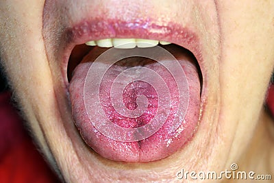 The tongue is red, inflamed. Hyperemia of the mucous membrane of the tongue Stock Photo