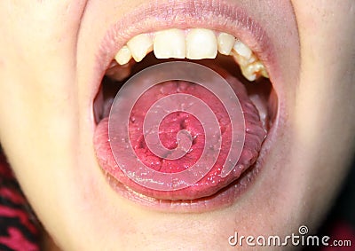 The tongue is red, inflamed. Hyperemia of the mucous membrane of the tongue Stock Photo