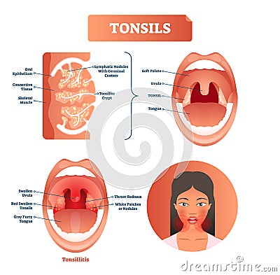 Tonsils vector illustration. Tonsillitis labeled structure diagram. Vector Illustration