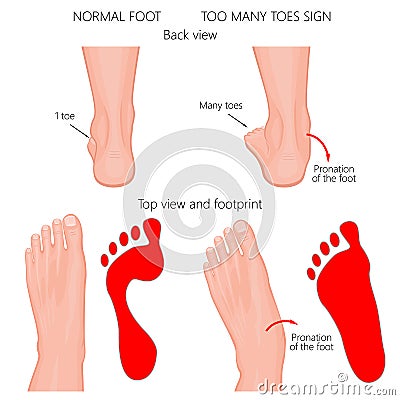Too many toes Vector Illustration