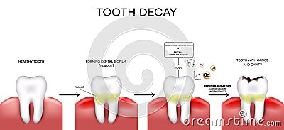 Tooth caries and cavity Vector Illustration