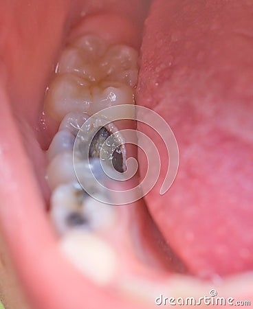 Tooth caries Stock Photo