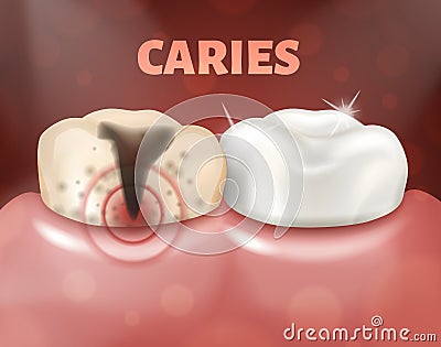 Tooth with caries and healthy tooth. 3d realistic illustration of dental disease. Deep caries on a sick tooth Vector Illustration