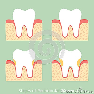 Step of periodontal disease / periodontitis / gingivitis / gum disease, dental problem Vector Illustration