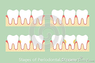 Step of periodontal disease / periodontitis / gingivitis / gum disease, dental problem Vector Illustration