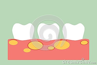 Unhealthy teeth because gingivitis with abscess in gum and dental plaque or tartar Vector Illustration