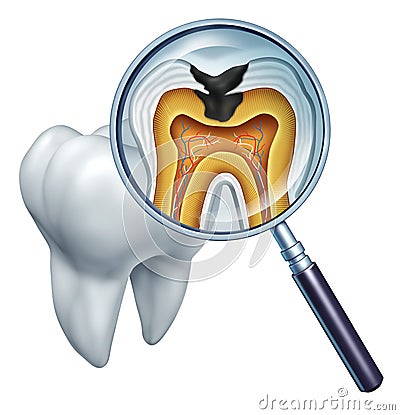 Tooth Cavity Close Up Stock Photo