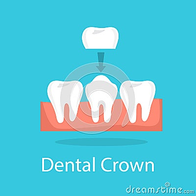 Tooth crown. Dentistry and implant procedure concept Vector Illustration