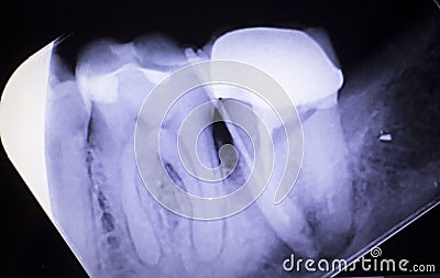 Tooth crown root canal Stock Photo