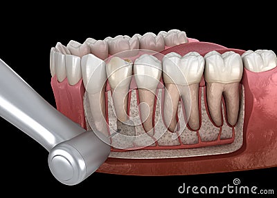 Tooth Cystectomy Surgery - recovery after Periostitis . Medically accurate 3D illustration Cartoon Illustration