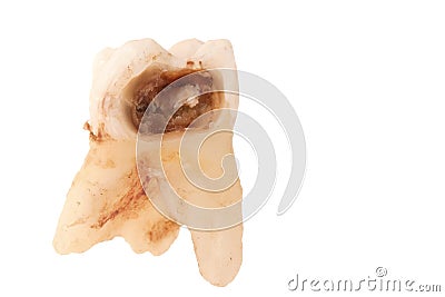 Tooth decay Stock Photo