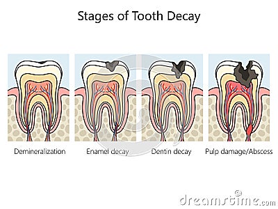 Tooth decay caries stages diagram medical science Vector Illustration