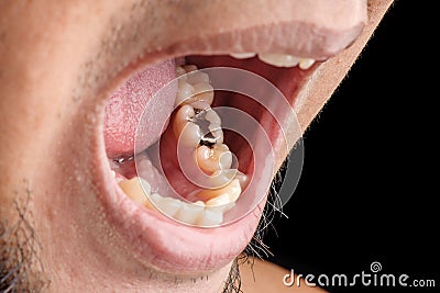 Tooth filling Stock Photo