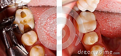 Tooth filling by dentist Stock Photo