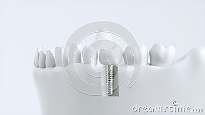 Tooth human implant - 3d rendering Stock Photo