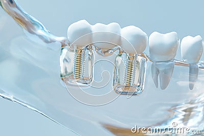 Tooth human implant - 3D Rendering Stock Photo