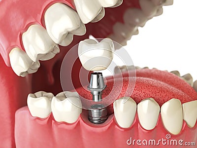 Tooth human implant. Dental concept. Human teeth or dentures. Cartoon Illustration