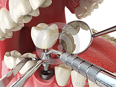 Tooth human implant. Dental implantation concept. Human teeth or Cartoon Illustration