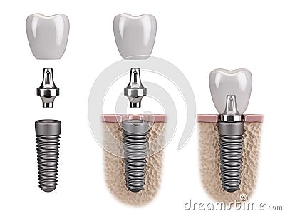 Tooth human implant Stock Photo