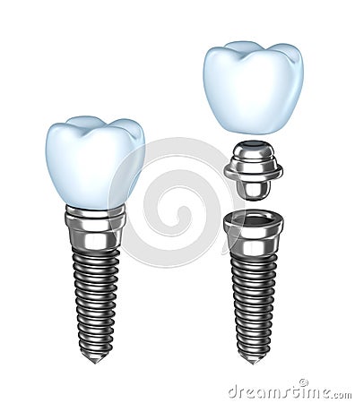 Tooth implant Stock Photo