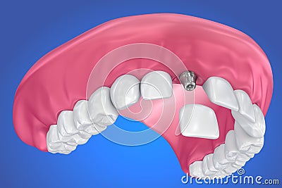 Tooth implant and crown installation process Cartoon Illustration