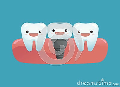 Tooth implant Vector Illustration