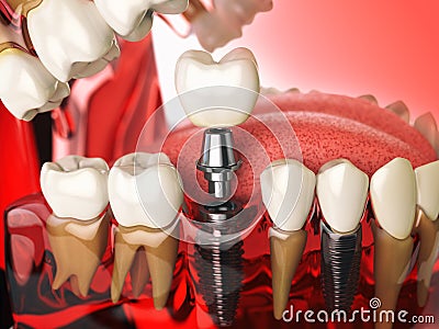 Tooth implant in the model human teeth, gums and denturas. Dental medicine stomatology concept. Cartoon Illustration