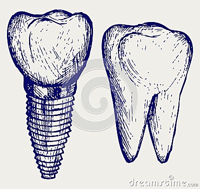 Tooth implant and molar Vector Illustration