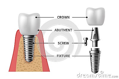 Tooth implant. Realistic implant structure pictorial models crown. Abutment, screw denture orthodontic implantation Vector Illustration