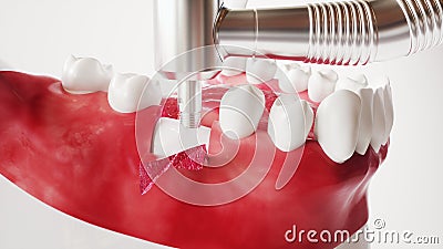 Tooth implantation picture series 5 of 13 - 3D Rendering Stock Photo