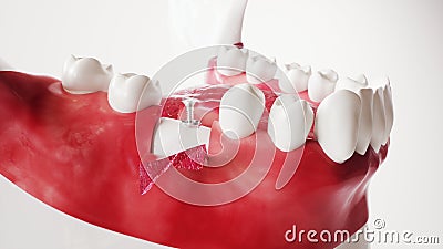Tooth implantation picture series 7 of 13 - 3D Rendering Stock Photo