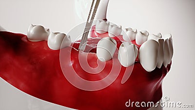 Tooth implantation picture series 2 of 13 - 3D Rendering Stock Photo