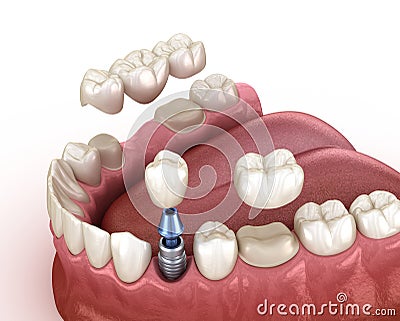 Tooth recovery with implant and crown. Medically accurate illustration dental concept Cartoon Illustration