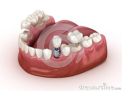 Tooth recovery with implant and crown. Medically accurate illustration dental concept Cartoon Illustration