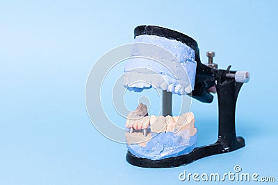 Tooth recovery with implant. Plaster model of teeth. Upper and lower jaws plaster model with prepared teeth. White front Stock Photo