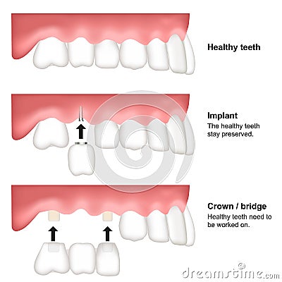Tooth replacement dental medical vector illustration isolated on white background Vector Illustration