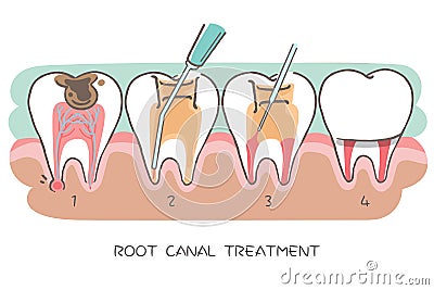 Tooth with root canal treatment Vector Illustration