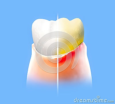 Tooth, sore gum, redness, dentistry, dental cleaning, oral hygiene. Using toothpaste to protect the tooth Stock Photo